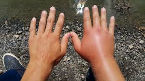 Hand swelling